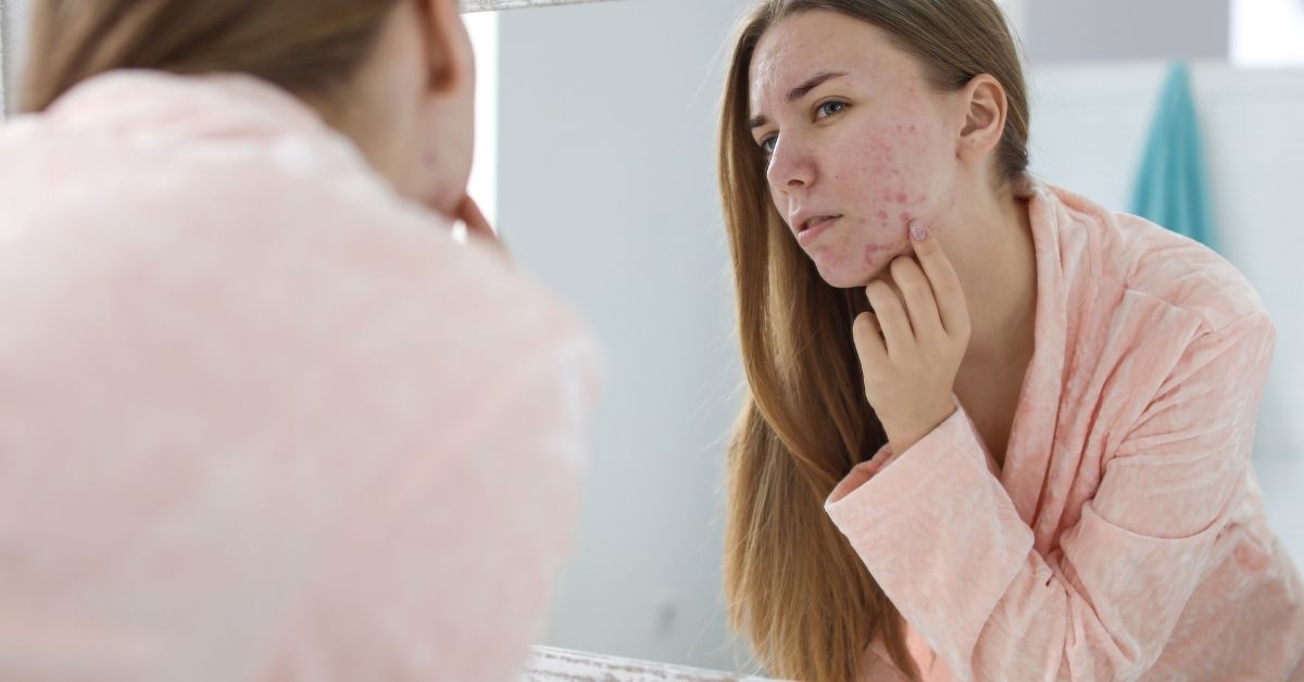 Comprendre l’acné adulte pour la vaincre définitivement