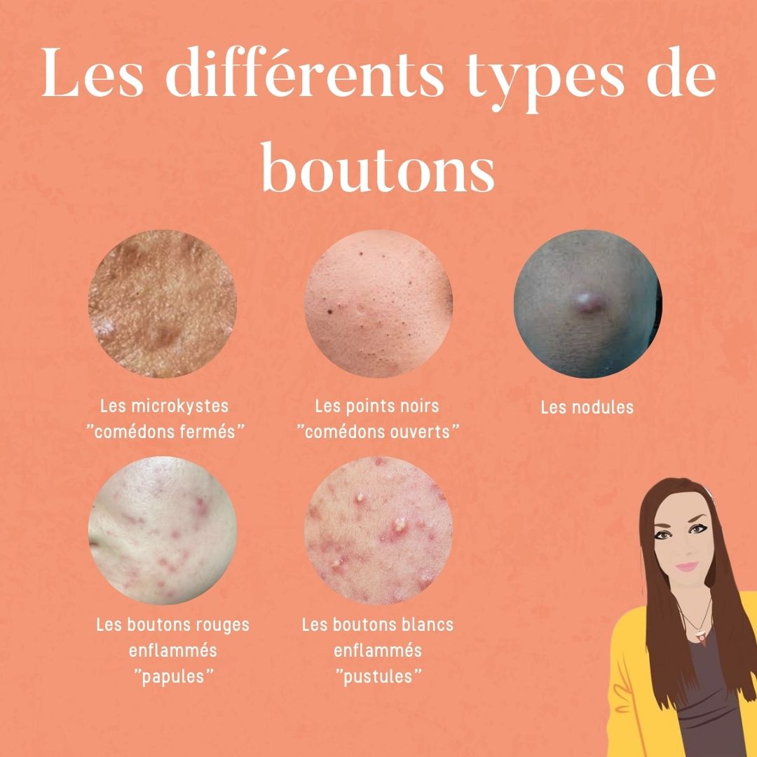 Causes Boutons Visage Diff rent Type De Bouton Visage VCOG