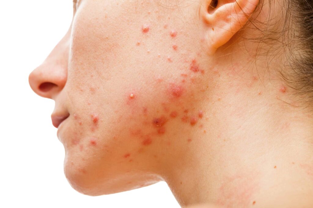 Acné hormonale de la femme, inflammation, acné digestive