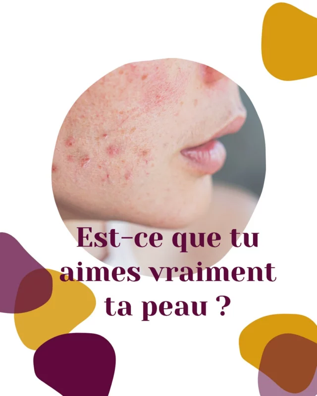 ✨ Est-ce que tu aimes vraiment ta peau ?
Attention… piège.

Quand je pose cette question à mes clientes, elles pensent immédiatement à leur reflet, leurs imperfections, ce qu’elles veulent corriger.

Mais ta peau, ce n’est pas juste une image.
C’est un organe VIVANT, connecté à tout ton corps.
Un monde vivant, complexe, intelligent…
Et plus tu lui fais la guerre, plus elle se défend.

Je le sais, je suis passée par là.
À force de vouloir à tout prix « corriger » ma peau, je me suis épuisée…
Et mon corps, lui, a fini par dire STOP.

Aujourd’hui, si tu es dans cette spirale infernale où tu alternes crèmes, régimes et désespoir…
C’est que personne ne t’a appris à voir ta peau autrement.

C’est EXACTEMENT pour ça que je t’invite à ma conférence offerte :
🔴 « Les 3 vérités sur l’acné hormonale qui t’empêchent de la résoudre durablement »
🗓 Le 26 mai à 20h30 en live sur Zoom.

⚡ Je vais t’expliquer pourquoi tu tournes en rond.
Et surtout comment commencer à t’en libérer, sans t’auto-saboter, ni t’épuiser.

👉 Les places sont limitées.
Réserve ta place via le lien dans ma bio.

👉 Participantes de mes programmes et professionnels : merci de laisser votre place. 

Et rappelle-toi : ton corps n’est pas ton ennemi.
Commence par changer ton regard. 💜

Alexandra
__________
#acné #acné #acnésolution #acnéhormonal #santedelapeau #peauacné #acnée #acneadulte #acnehormonale #acnéhormonale #peauacneique #acnee #anxieuse #hypersensible