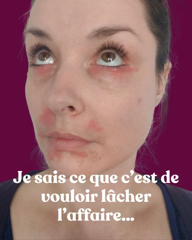 💔 Tu sais quoi…
Je comprends ce que tu ressens.
Parce que j’ai été à ta place.

J’ai connu l’épuisement de tout essayer.
Les routines parfaites, les régimes parfaits, les compléments parfaits.
Et malgré ça, ma peau s’emballait encore.

Je voulais lâcher l’affaire.
Vraiment.

Mais avec le recul, j’ai compris une chose essentielle :
Ce n’est pas ton corps qu’il faut lâcher.
C’est cette guerre contre lui qui va créer encore plus de tensions et de dérégulation de ton système nerveux. 
Et quand ton système nerveux est dérégulé, que tu tombes dans l'anxiété, c'est encore plus difficile à gérer. 

Parce qu’au bout, le corps finit toujours par dire STOP.
Et c’est toi qui perds : en temps, en confiance et en argent.

C’est exactement ce que je vais t’expliquer lors de ma conférence offerte :
👉 "Les 3 vérités sur l’acné hormonale qui t’empêchent de la résoudre durablement."
📅 Le 26 mai à 20h30
📍 En ligne, sur Zoom

Je ne fais quasiment jamais de live, alors profite-en si tu veux qu’on en parle ensemble.
⚡ Places limitées.

→ Clique sur le lien dans ma bio pour t'inscrire. 

Et surtout…
Sache que tu n’es pas seule.

Avec douceur,
Alexandra 💜
__________

#acnéadulte #acnéhormonale #peauetémotions #acnéféminine #stressetchronique #chargeémotionnelle #reconnexionaucorps #acnéliberation #acnéfrance #acnéjourapresjour