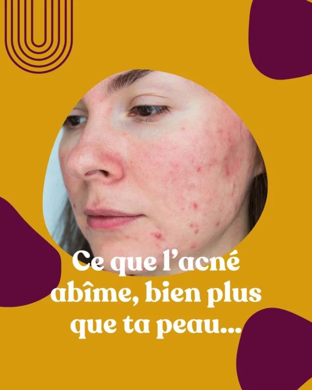 💔 Ce que l’acné abîme… ce n’est pas juste ta peau.
C’est aussi ton rapport à toi-même.

Tu doutes. Tu te caches. Tu t’effaces.

Petit à petit, tu perds ce truc essentiel :
👉 croire en toi.
👉 te sentir à ta place.
👉 oser poser des limites.
👉 oser te montrer telle que tu es.

Et tout ça, juste à cause de ce que tu vois dans le miroir.

Mais tu veux que je te dise ?
Ce n’est pas une fatalité.
Et surtout : ce n’est pas de ta faute.

Parce que ton acné hormonale n’est pas qu’un “problème de peau”.
C’est le signal d’un corps en surcharge, en tension, en mode survie.

Et ça, personne ne t’a jamais appris à l’écouter.

📍Lundi 26 mai à 20h30, je t’explique tout ça dans une conférence offerte :
« Les 3 vérités sur l’acné hormonale qui t’empêchent de la résoudre durablement »

🎯 Sans chichis. Sans bullshit.
Juste toi, moi, et des explications qui vont vraiment te faire avancer.

⚡ Les places sont limitées.
→ Lien d’inscription dans ma bio.

Avec cœur,
Alexandra 💜
__________
#acné #acnéhormonale #hypersensible #hypersensiblité #introvertie #introversion #anxiété #anxiete