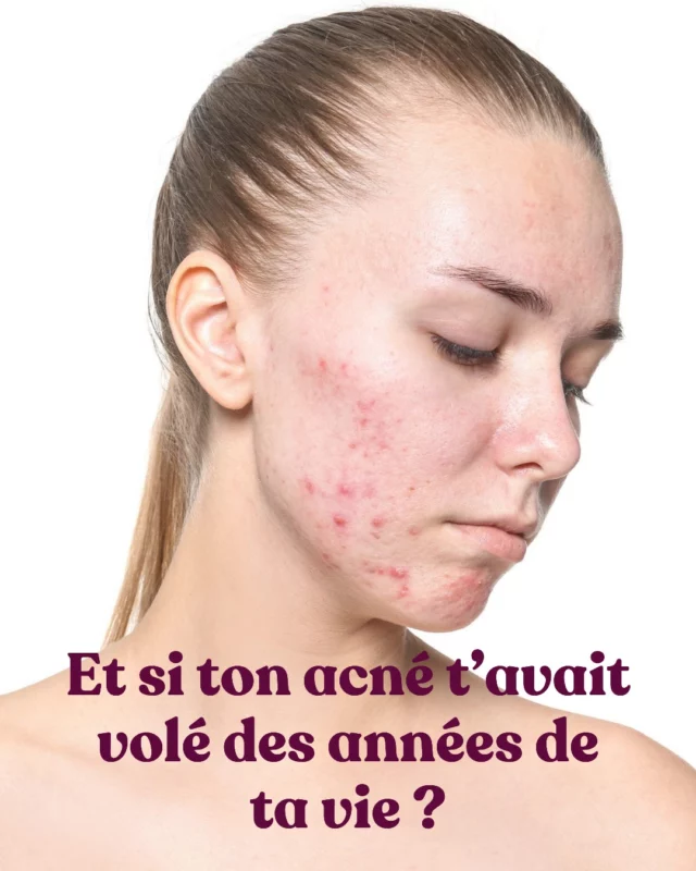 💔 Et si ton acné t’avait volé des années de ta vie ?

Je te pose la question avec bienveillance.

Parce que je sais ce que c’est.

👉 Faire semblant d’être bien dans sa peau alors qu’à l’intérieur, tu hurles.

👉 Refuser des soirées, des vacances, des moments simples… juste parce que tu ne supportes pas qu’on voie ta peau nue.

👉 Porter du fond de teint pour aller au sport. Pour ouvrir au livreur. Pour se regarder dans le miroir.

Tu crois cacher ton acné aux autres.
Mais au fond, c’est à toi que tu caches la vérité.

Tu ne vis plus vraiment.
Tu survis.

Et crois-moi, je ne te juge pas.
J’ai été cette femme aussi.
Celle qui a mis sa vie entre parenthèses parce que sa peau n’était “pas montrable”.

Et tu sais quoi ?
C’est encore plus douloureux que les boutons eux-mêmes.

Aujourd’hui, j’ai 39 ans.
Et parfois, j’ai la sensation d’avoir commencé à vivre beaucoup trop tard.

🎁 C’est pour ça que j’ai créé Hack ta Peau.
Pas pour “juste” une peau jolie.
Mais pour que tu retrouves la liberté de vivre sans masque, sans fuite, sans peur du regard.

📆 Les inscriptions ferment lundi soir.
→ Si tu veux en savoir plus, écris-moi “Hack” en message privé.

Tu mérites de reprendre ta vie en main.

Avec bienveillance,
Alexandra 💜
__________

#peauetémotions #acnéadulte #acnéhormonale #chargeémotionnelle #hypervigilance #acnéjourapresjour #thegoodbalance #reconnexionàsoi #libérationféminine #vivelibre #anxiétéféminine #acnéféminine