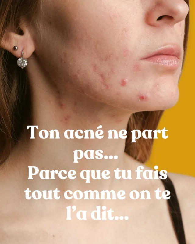 ✨ Tu fais tout comme on te l’a dit… et pourtant, ton acné est toujours là.

Tu suis les comptes Insta.
Tu testes les routines clean.
Tu achètes les compléments “miracles”.
Tu appliques les diagnostics express de pseudos experts.

Mais au fond… tu sens bien que quelque chose cloche.

👉 Parce qu’aucun de ces conseils ne t’apprend à comprendre vraiment ton corps.
À écouter ce qu’il essaie de te dire à travers ta peau.
À entendre ses signaux de stress, de dérégulation, de surcharge.

C’est exactement ce que je t’explique dans Hack ta Peau.
Pas de recette miracle.
Pas de bullshit marketing.
Mais une méthode profonde, structurée et incarnée, avec une vraie expertise derrière.
Pour enfin sortir du flou et reprendre le pouvoir.

🎯 Si tu veux voir ou revoir ma masterclass « Les 3 vérités sur l’acné hormonale qui t’empêchent de la résoudre durablement », le replay est encore dispo jusqu’à ce soir.
Écris-moi en MP ou commente « replay » et je t’envoie le lien avec plaisir.

Et si tu sens que c’est le moment de reprendre ta peau (et ta vie) en main…
👉 Les portes de Hack ta Peau ferment demain soir. Tu peux encore rejoindre l’aventure.

Tu sais où me trouver. 

Alexandra 💜
___________

#acnéhormonale #acnéadulte #femmesatypiques #acnéféminine #derèglementhormonal #acnéetstress #thérapienaturelle #peauetémotions #reconnexionaucorps #hacktapeau #acné #acnesolution
